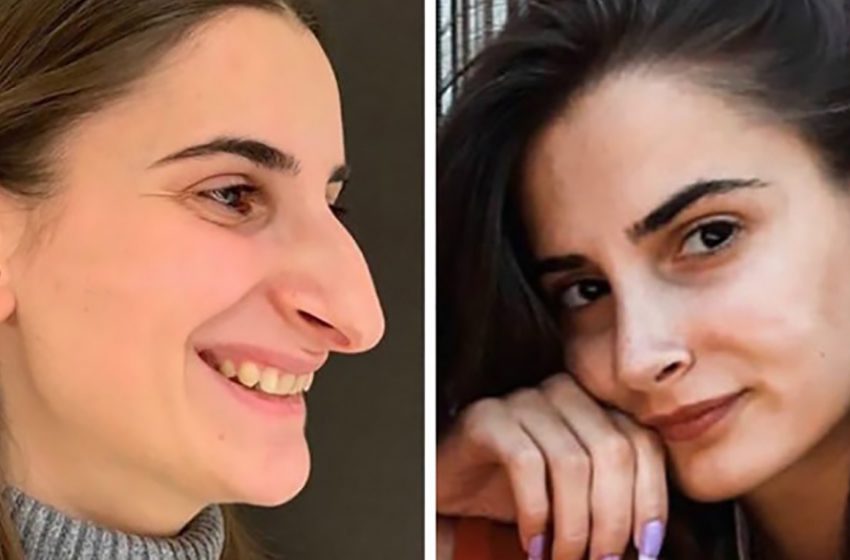  Έχουν αλλάξει πλήρως: Φωτογραφίες απλών κοριτσιών από το διαδίκτυο, που είναι εμφανώς βελτιωμένες με πλαστική χειρουργική.