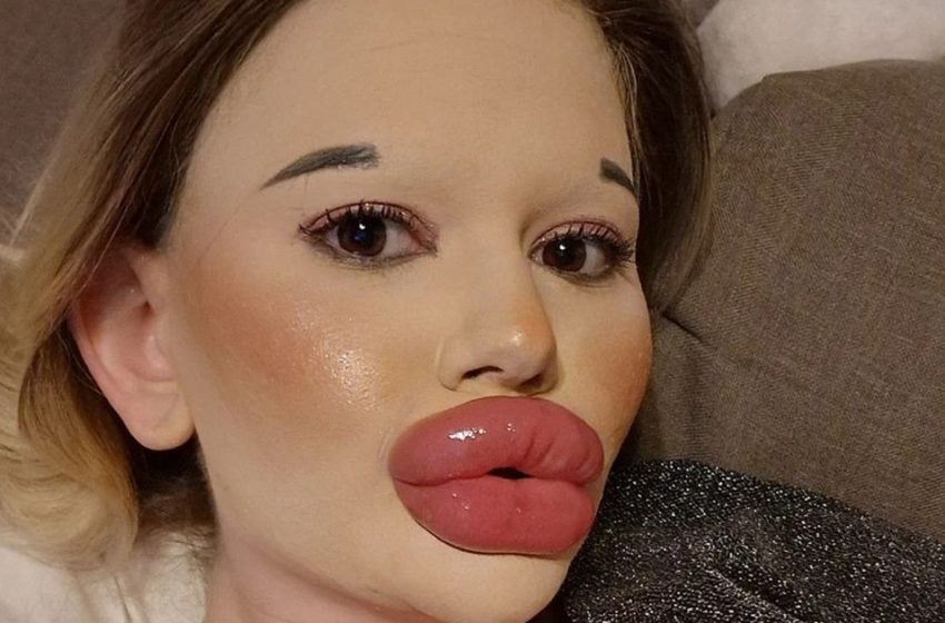  Μια 25χρονη κοπέλα έχει υποβληθεί σε περισσότερες από 27 διαδικασίες: Τώρα έχει τα μεγαλύτερα χείλη στον κόσμο!