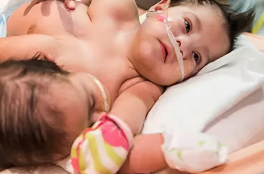 Η Απίστευτη Ιστορία των Σιαμαίων Διδύμων που Νίκησαν τις Πιθανότητες!: Δες Πώς Είναι Σήμερα!