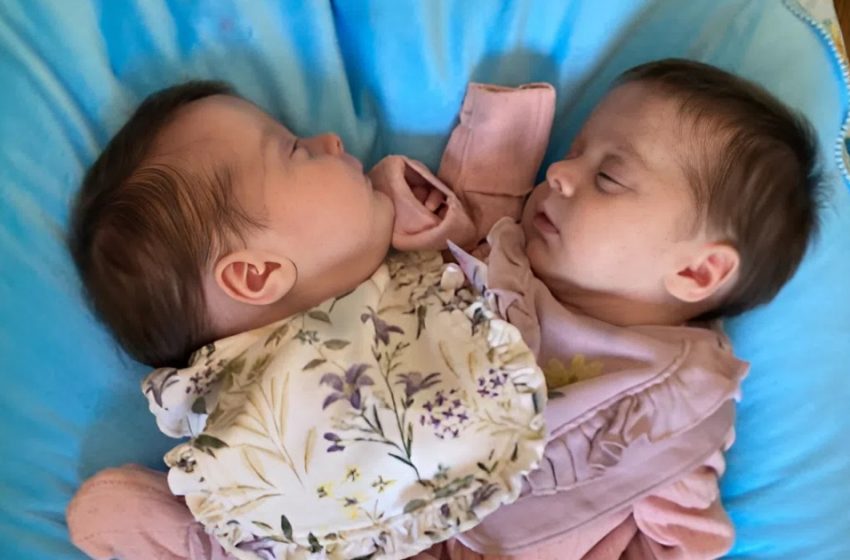 Από σιαμαία ενωμένα στο στήθος σε ευημερούντα παιδιά: τα δίδυμα 3 χρόνια μετά τον διαχωρισμό — δείτε τις φωτογραφίες τους